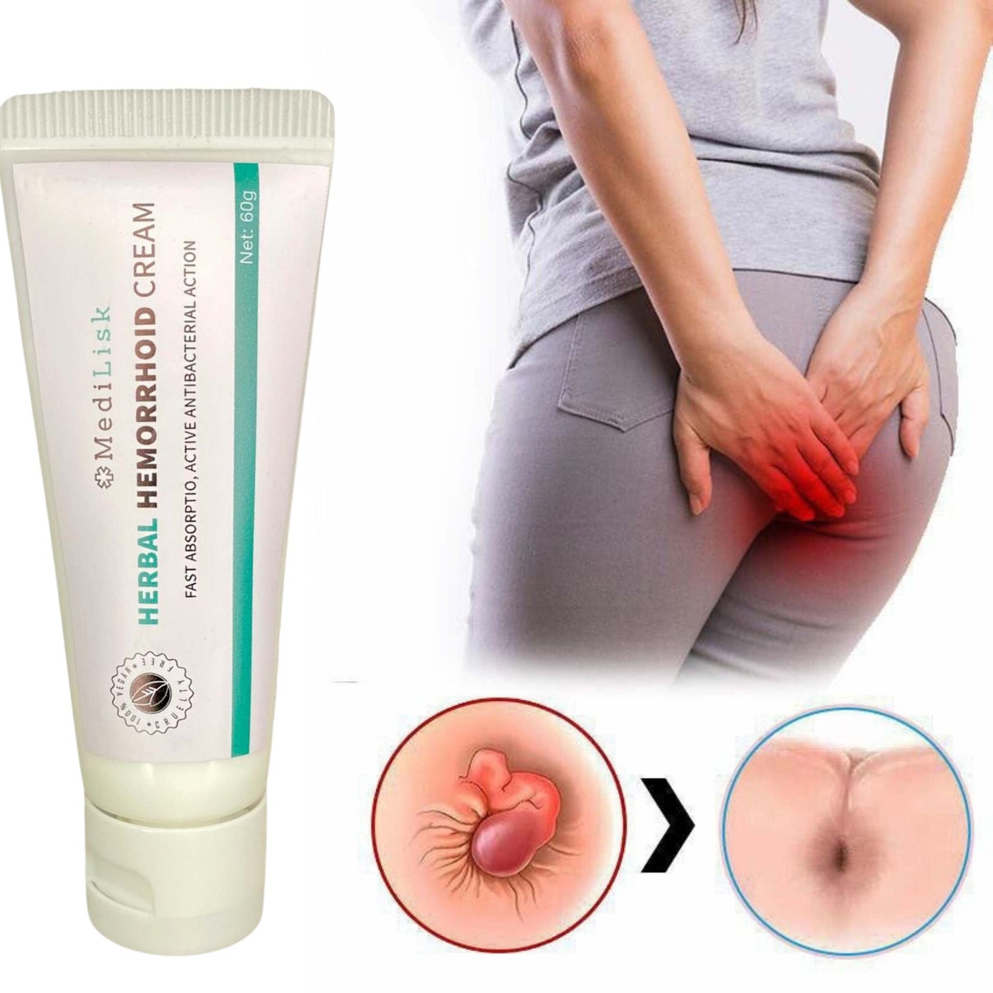 Crema Herbal Hemorrhoid® - Desaste de las hemorriodes para siempre