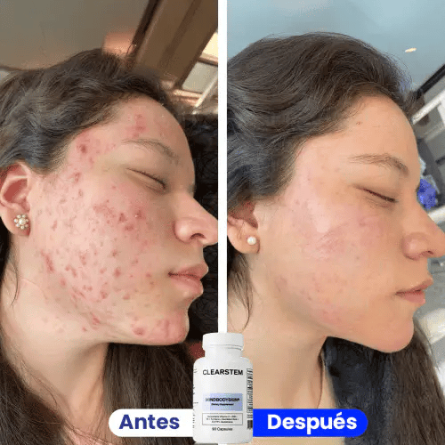 Antes y despues CLEARSTEM MINDBODYSKIN