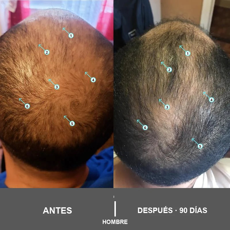 revita-shampoo 02_antesdespues.webp